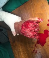 ტრავმული ამპუტაცია თითების ფალანგების კანის დეფექტით ოპერაციამდე